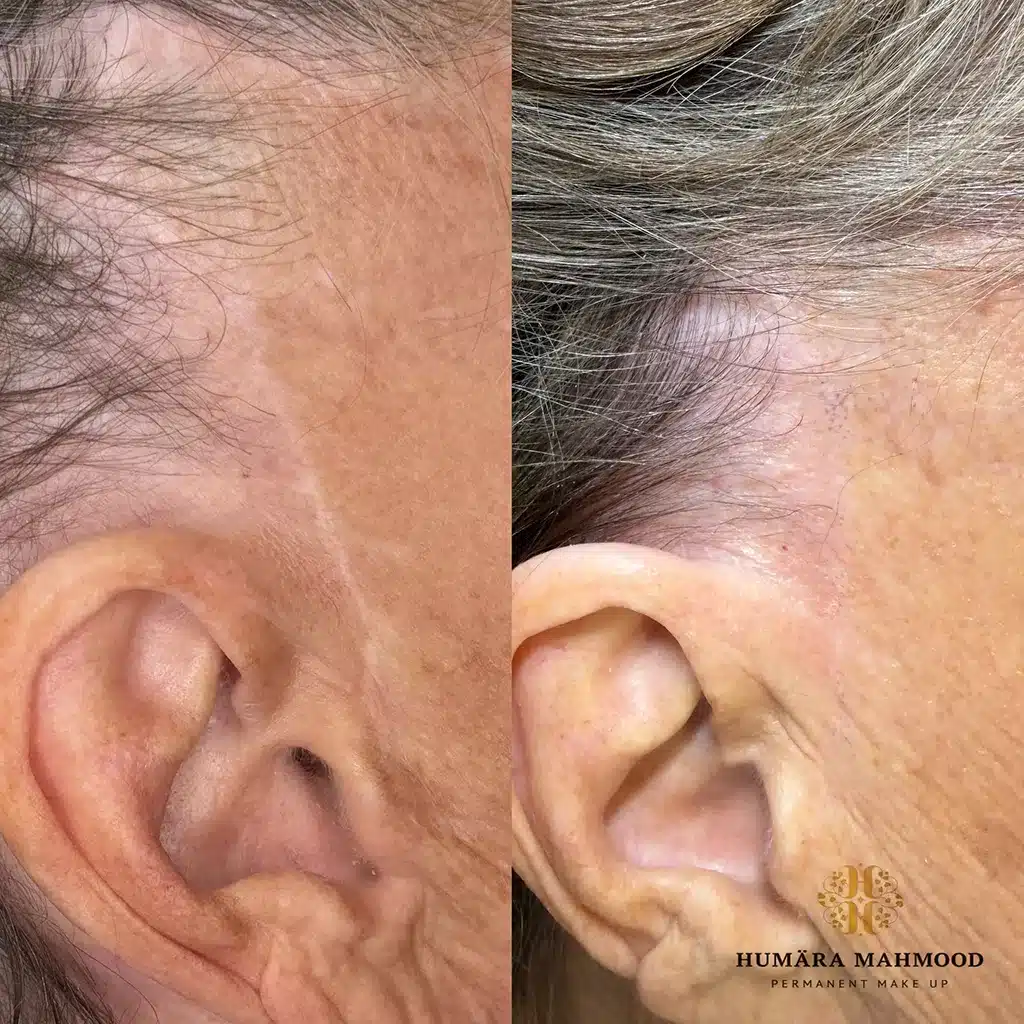 Facelifting Narbe