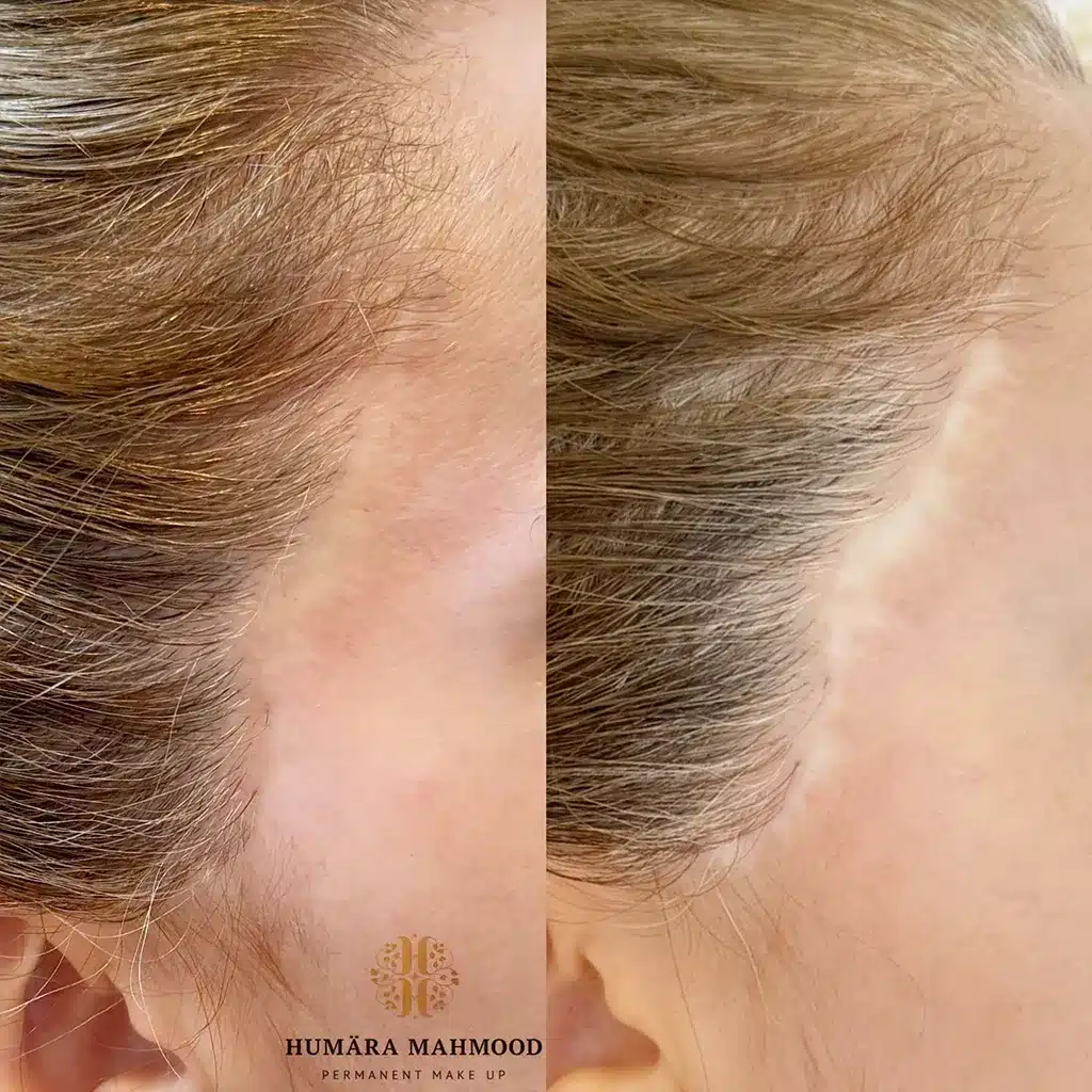 Facelifting Narbe