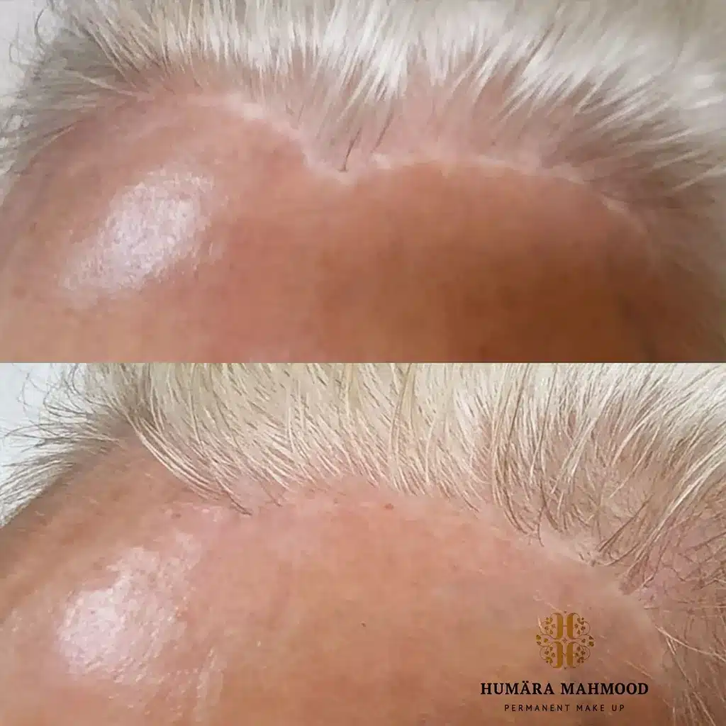 Facelifting Narbe