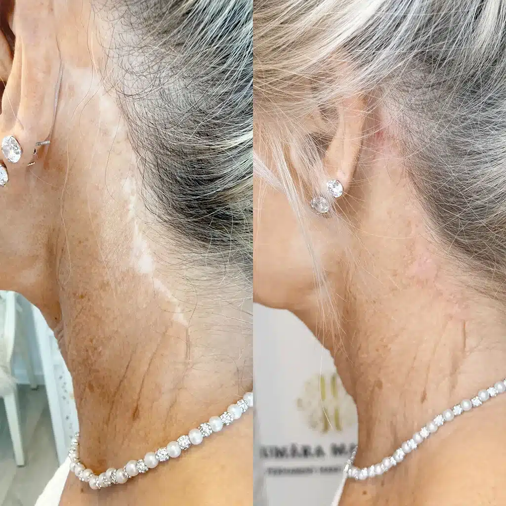 Facelifting Narbe