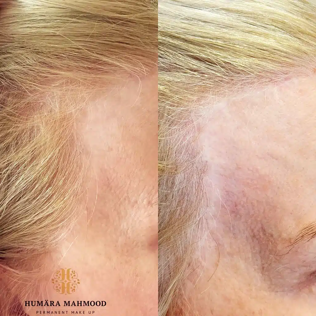 Facelifting Narbe