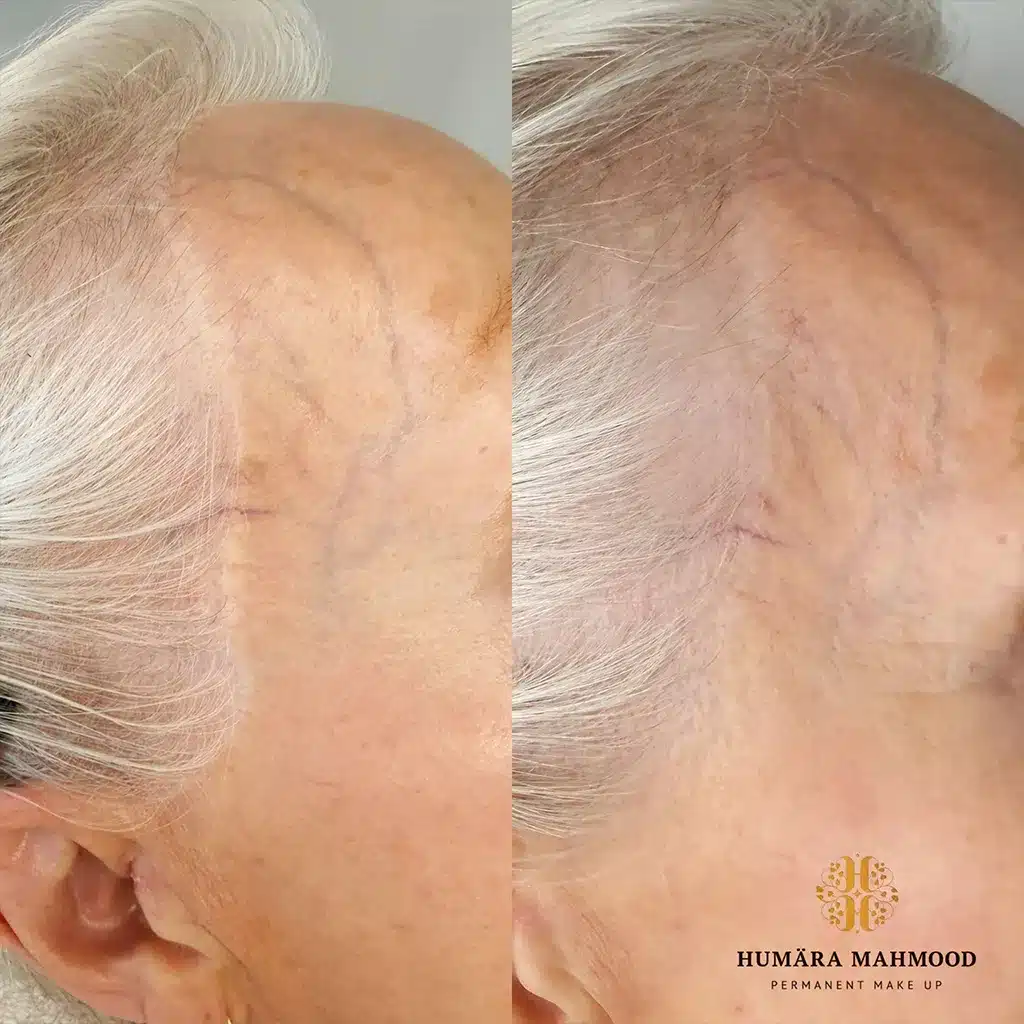 Facelifting Narbe